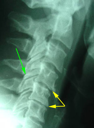 disc degeneration treated at Gormish Chiropractic & Rehabilitation