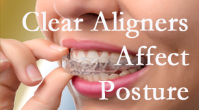 Clear aligners influence posture which Carrolltown chiropractic helps.