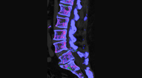 Gormish Chiropractic & Rehabilitation is aware that inflammatory spinal gout is a differential diagnosis to consider for patients who present with back pain and other spine related symptoms.