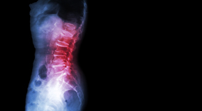 Carrolltown Chiropractic Care of Spondylolisthesis 