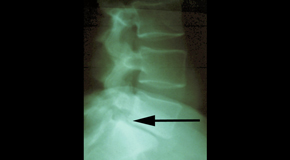 Carrolltown spondylolisthesis 