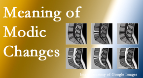 Gormish Chiropractic & Rehabilitation sees many back pain and neck pain patients who bring their MRIs with them to the office. Modic changes are often noted. 