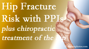 Gormish Chiropractic & Rehabilitation shares new research describing higher risk of hip fracture with proton pump inhibitor use. 