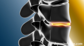 Carrolltown degenerative spinal changes 