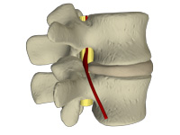 pinched nerve in the lower back