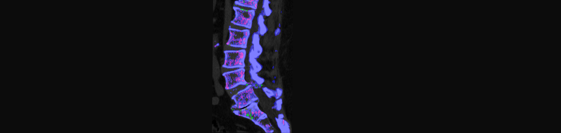 Gormish Chiropractic & Rehabilitation is aware that inflammatory spinal gout is a differential diagnosis to consider for patients who present with back pain and other spine related symptoms.