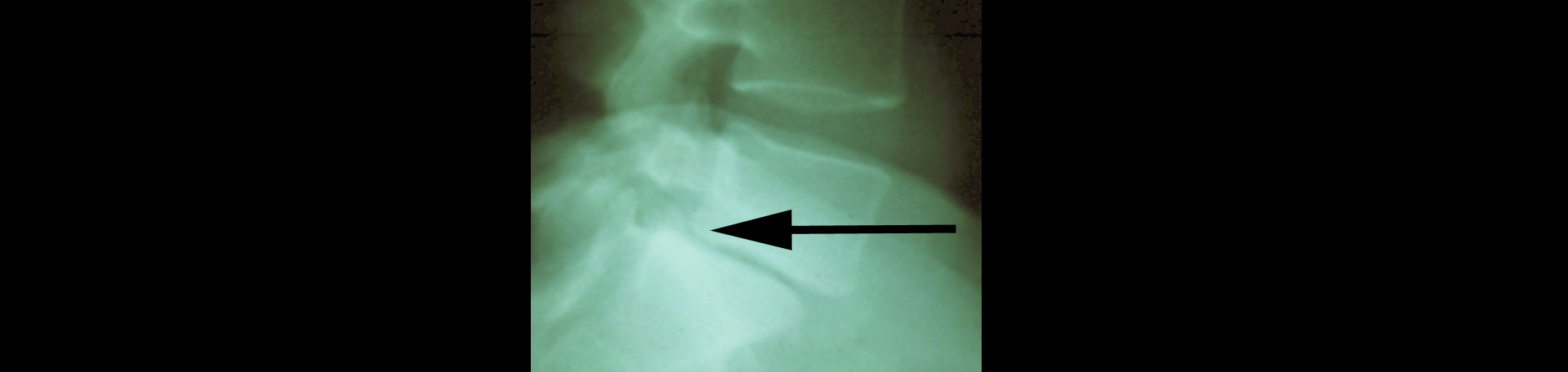 Carrolltown spondylolisthesis 