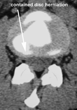 contained disc seen by pptargetlocation]] chiropractor