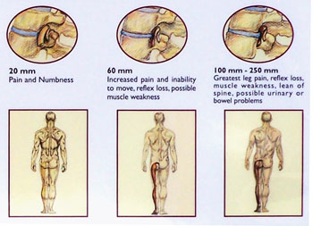 disc pressures