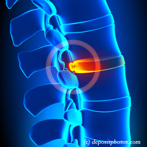 image of lumbar Carrolltown disc herniation