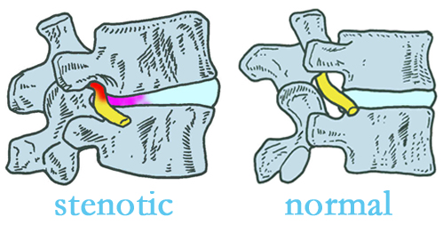 Carrolltown stenotic and normal spinal discs
